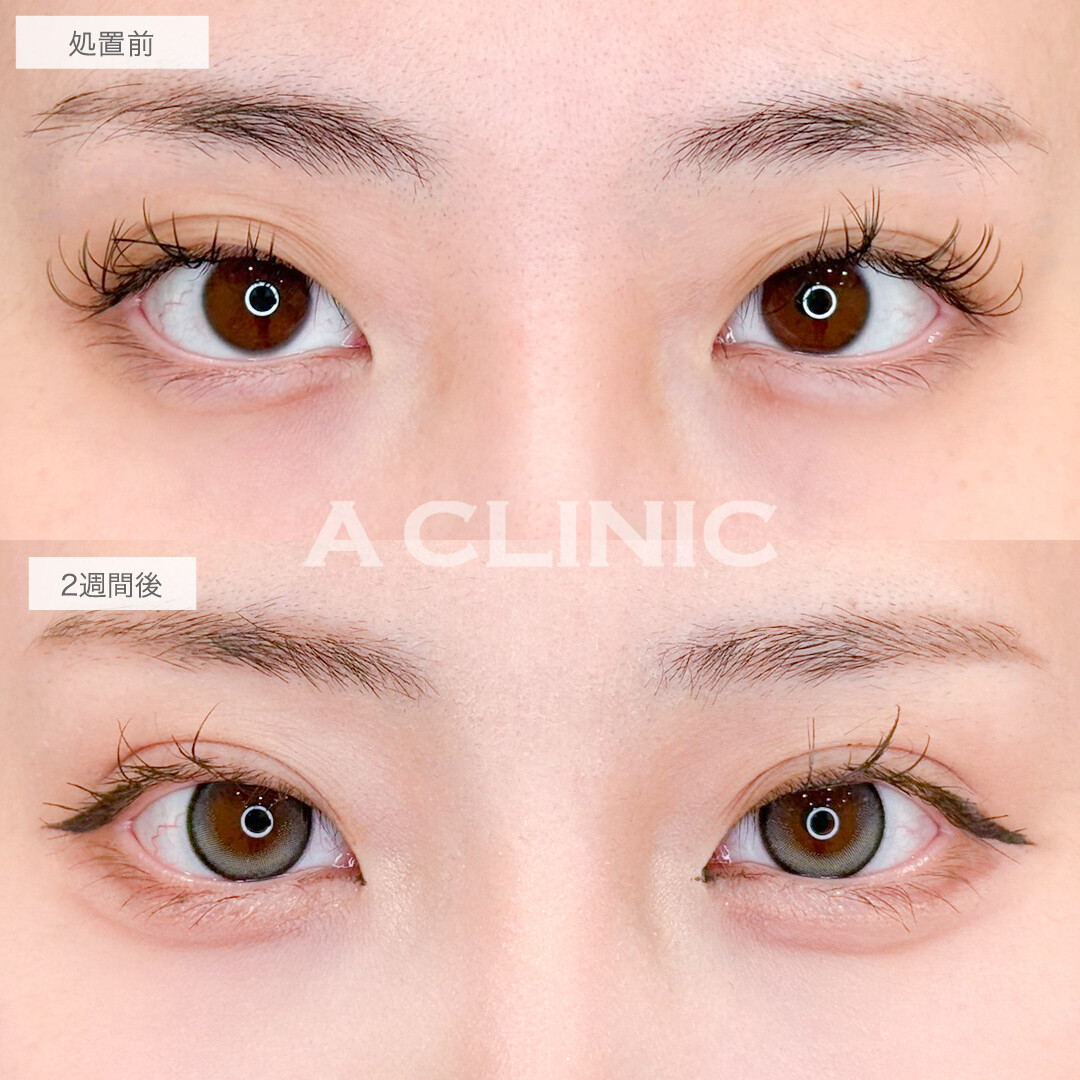 二重術埋没法でぼやけた二重ラインもぱっちり綺麗に！処置前と2週間後の症例です(20代女性)