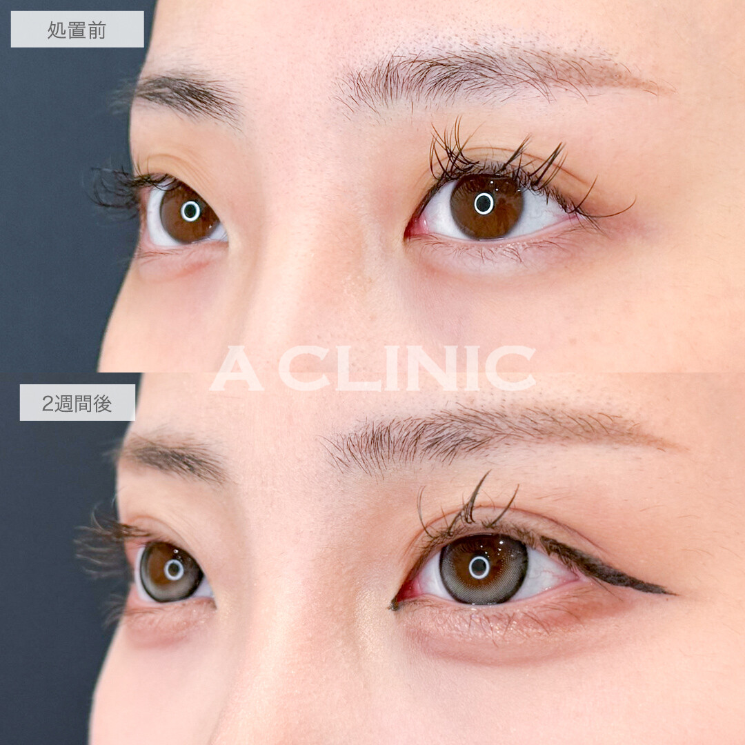 二重術埋没法でぼやけた二重ラインもぱっちり綺麗に！処置前と2週間後の症例です(20代女性)