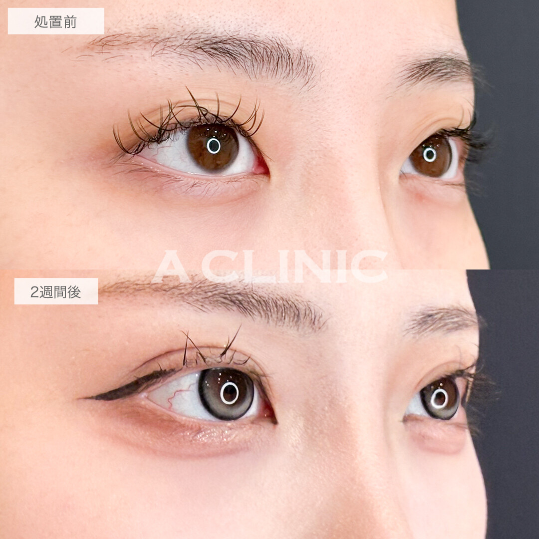 二重術埋没法でぼやけた二重ラインもぱっちり綺麗に！処置前と2週間後の症例です(20代女性)