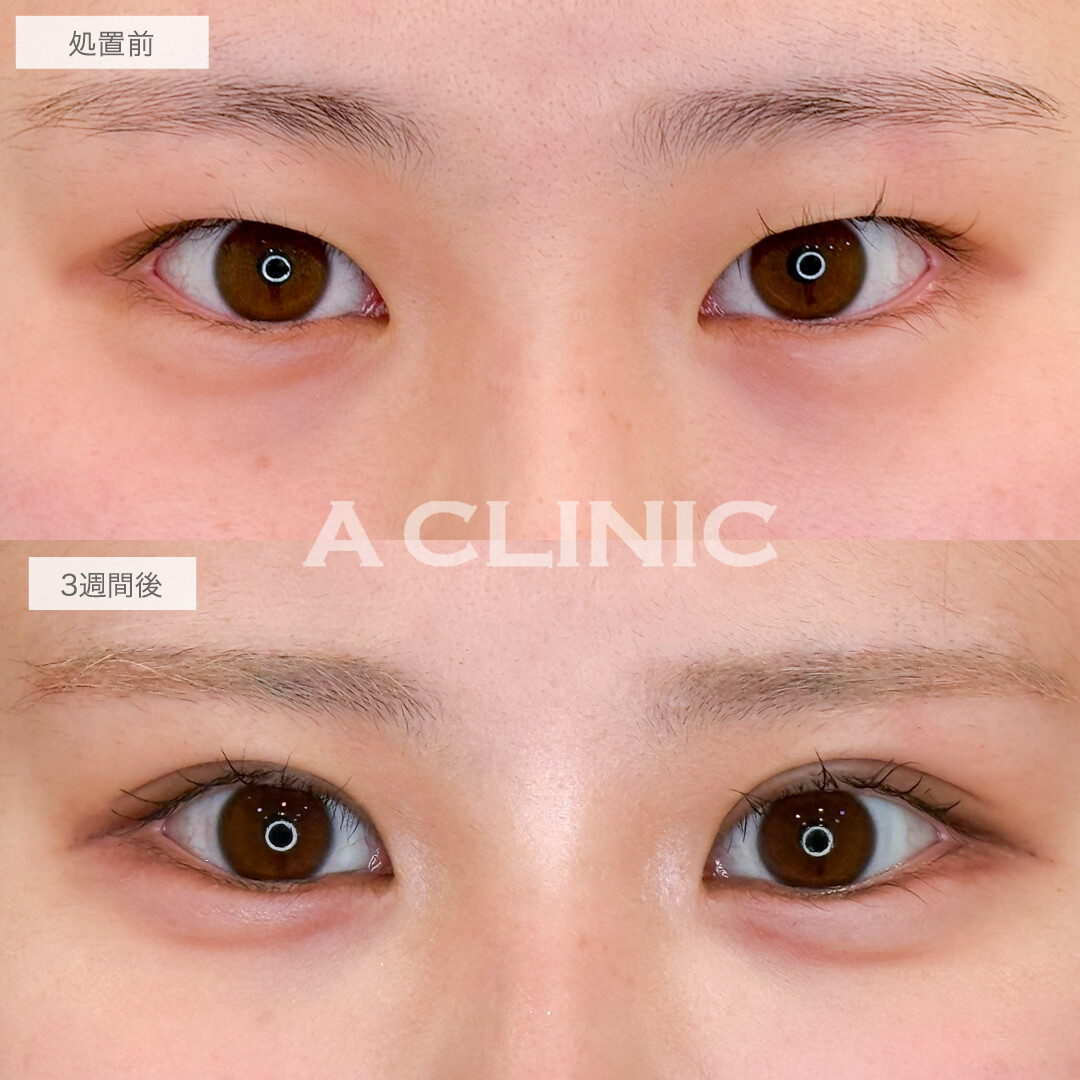 二重術埋没法でお目元の印象が激変！処置前と3週間後の症例です(20代女性)