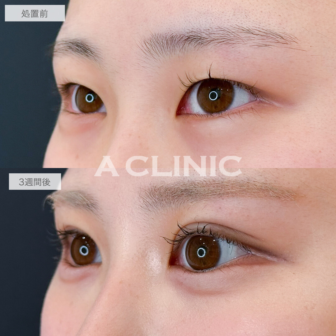 二重術埋没法でお目元の印象が激変！処置前と3週間後の症例です(20代女性)