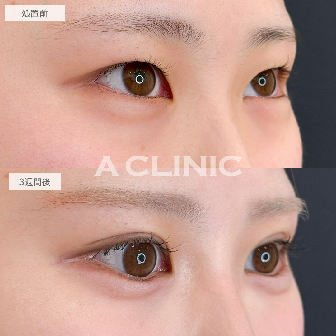 二重術埋没法でお目元の印象が激変！処置前と3週間後の症例です(20代女性)