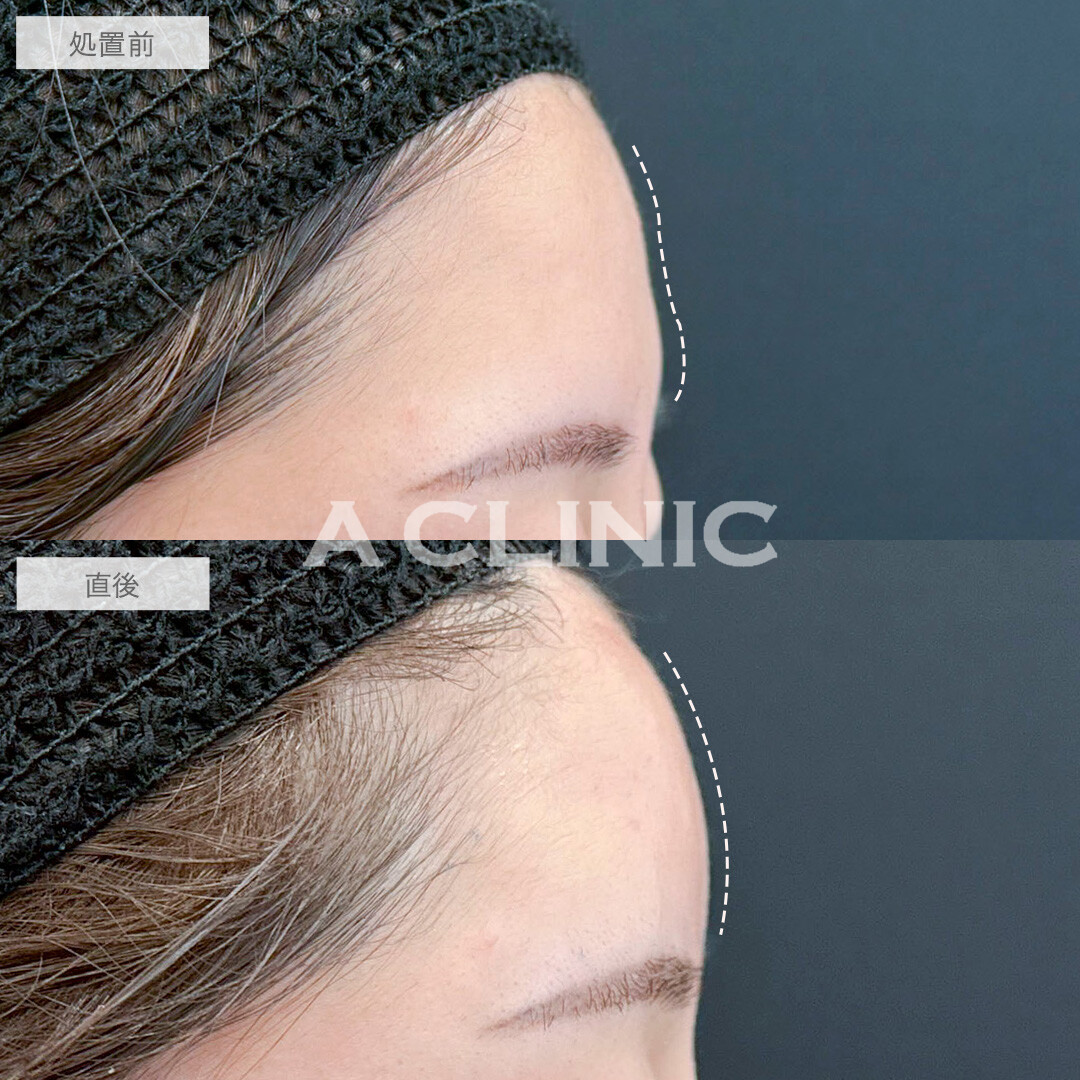 額出し、眉間深部、コメカミ形成(ヒアルロン酸注入)で丸みのある綺麗な額に！処置前と直後の症例です(20代女性)