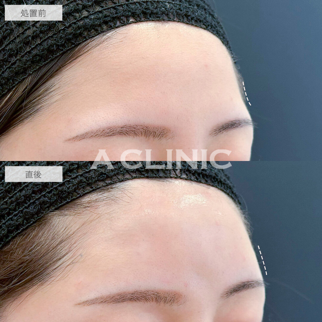 額出し、眉間深部、コメカミ形成(ヒアルロン酸注入)で丸みのある綺麗な額に！処置前と直後の症例です(20代女性)