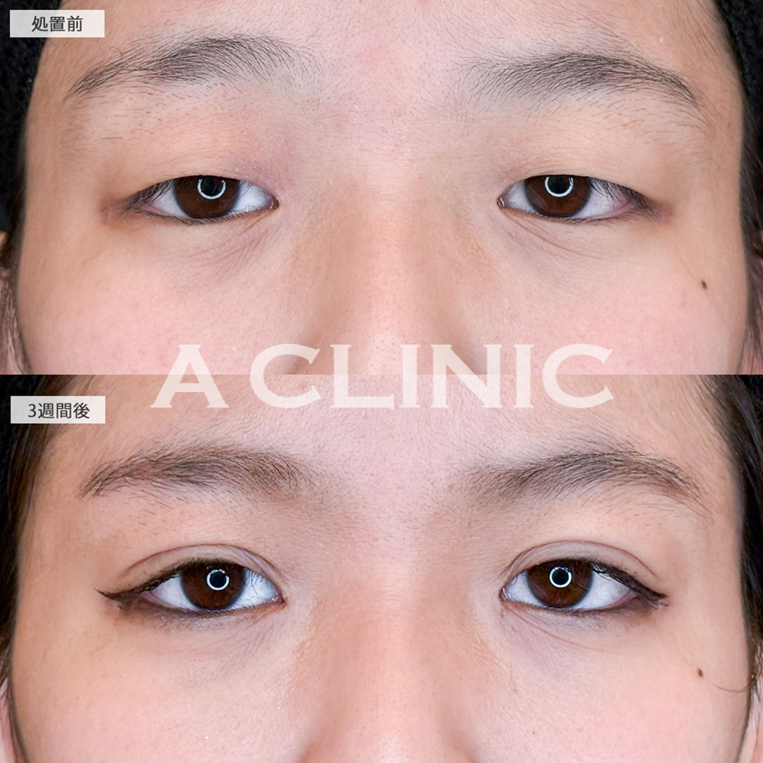 二重術埋没法と目の上の脂肪取りは一気に垢抜けます！こちら処置前と3週間後の症例です(10代女性)