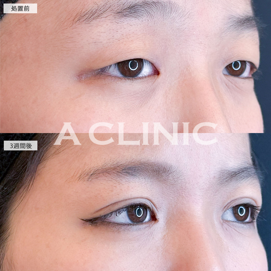 二重術埋没法と目の上の脂肪取りは一気に垢抜けます！こちら処置前と3週間後の症例です(10代女性)