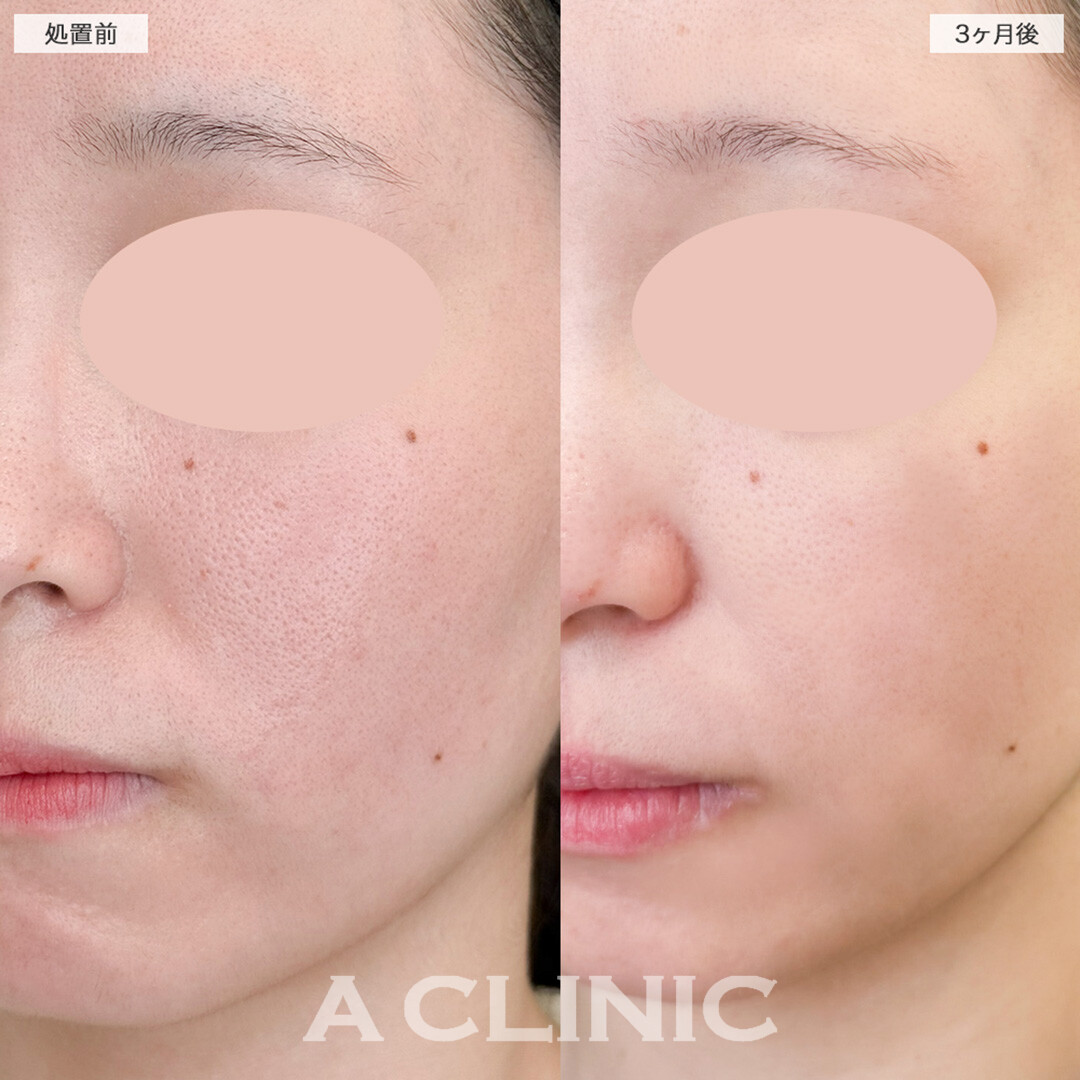 イソトレチノインで皮脂をコントロールし毛穴を引き締める！こちら処置前と3ヶ月後の症例です(20代女性)