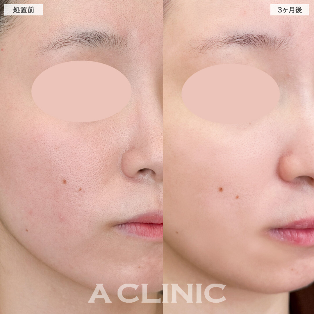 イソトレチノインで皮脂をコントロールし毛穴を引き締める！こちら処置前と3ヶ月後の症例です(20代女性)