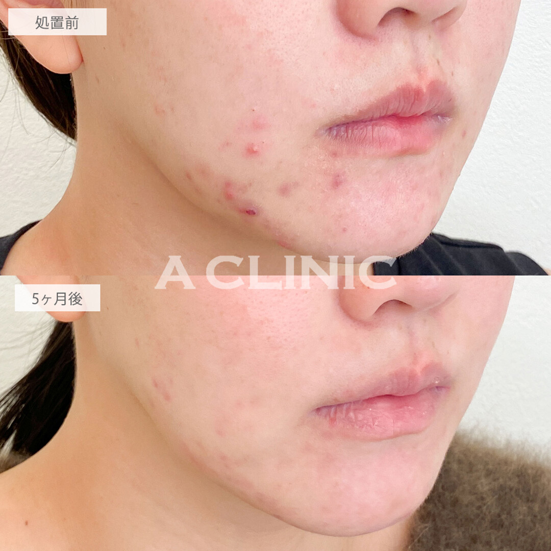 イソトレチノインで皮脂分泌を抑えてニキビ改善！こちら処置前と5ヶ月後の症例です(20代女性)