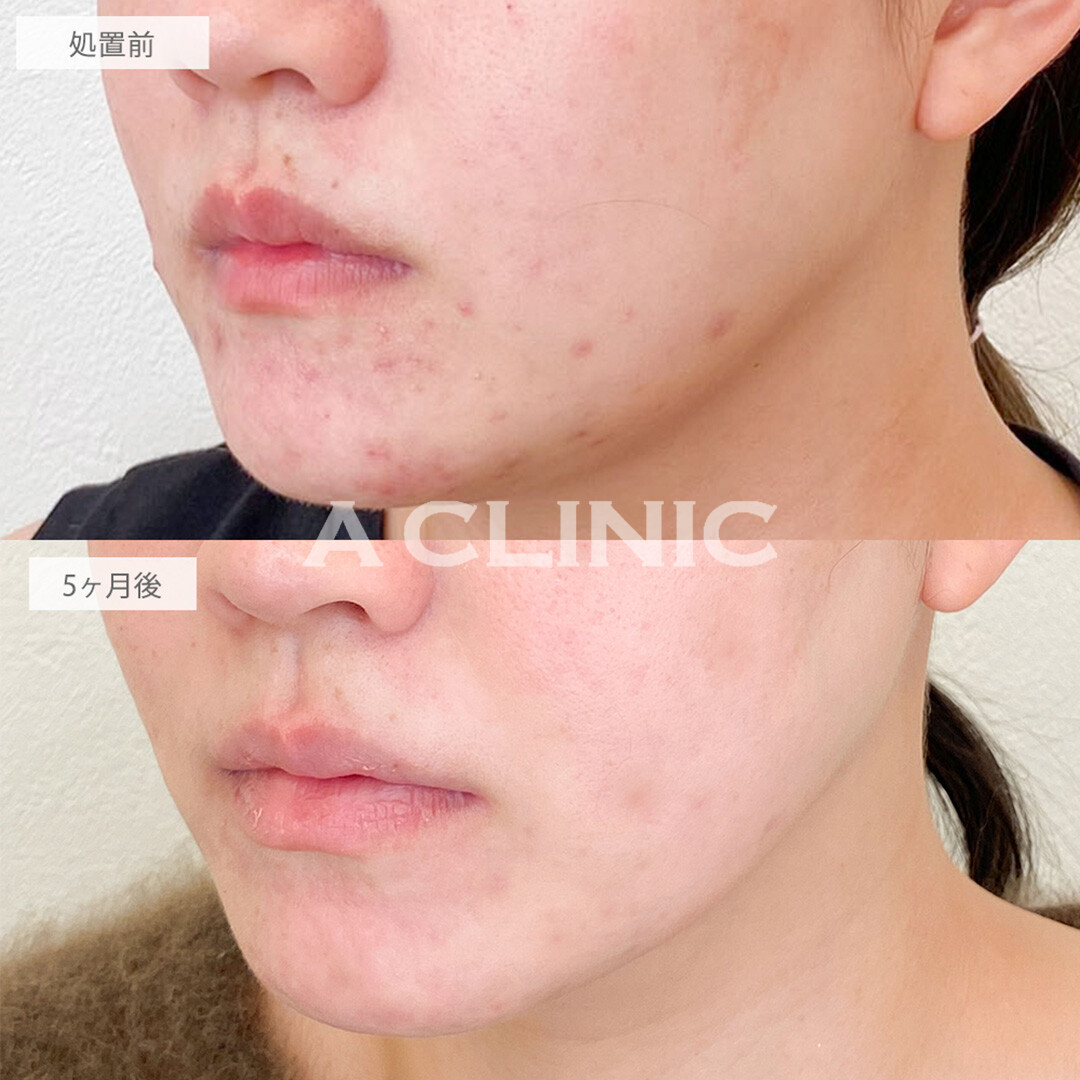 イソトレチノインで皮脂分泌を抑えてニキビ改善！こちら処置前と5ヶ月後の症例です(20代女性)