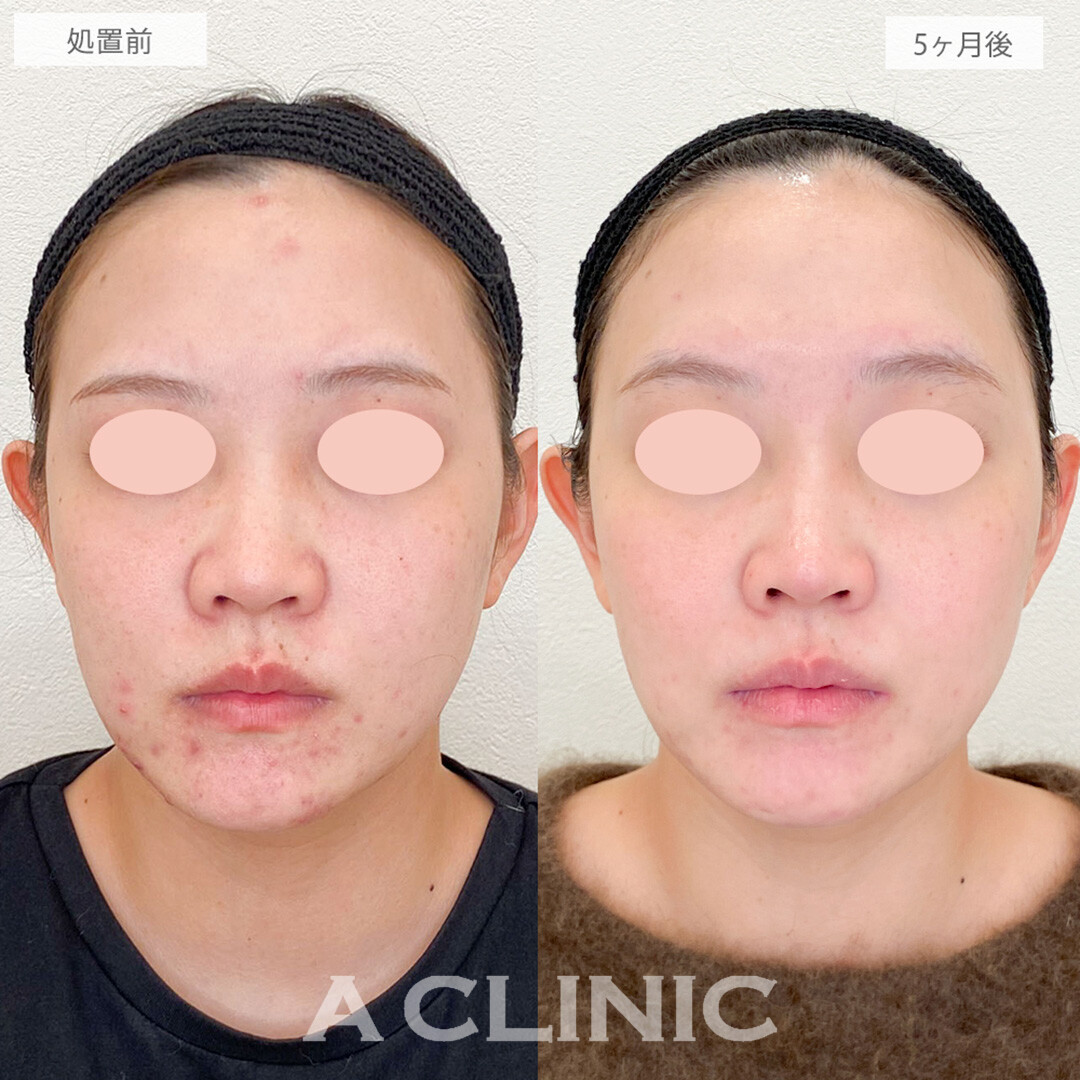 イソトレチノインで皮脂分泌を抑えてニキビ改善！こちら処置前と5ヶ月後の症例です(20代女性)