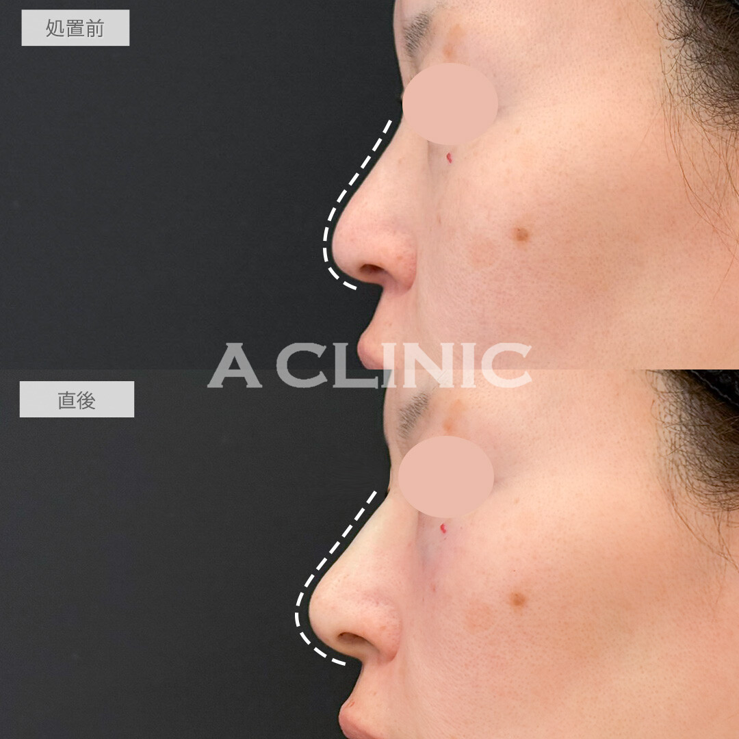 ジャスミンノーズで鼻全体を即日アップデートできました！処置前と直後の症例です(40代女性)
