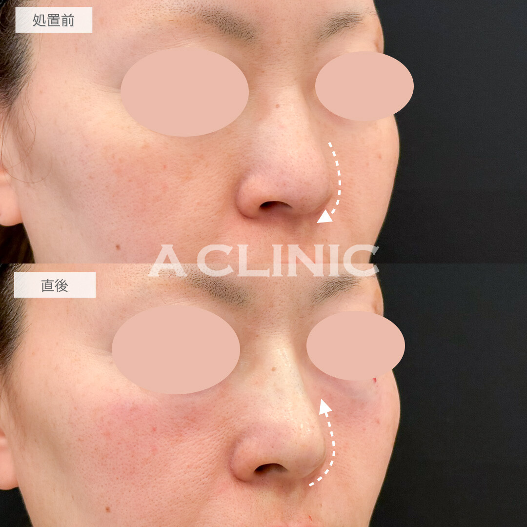 ジャスミンノーズで鼻全体を即日アップデートできました！処置前と直後の症例です(40代女性)