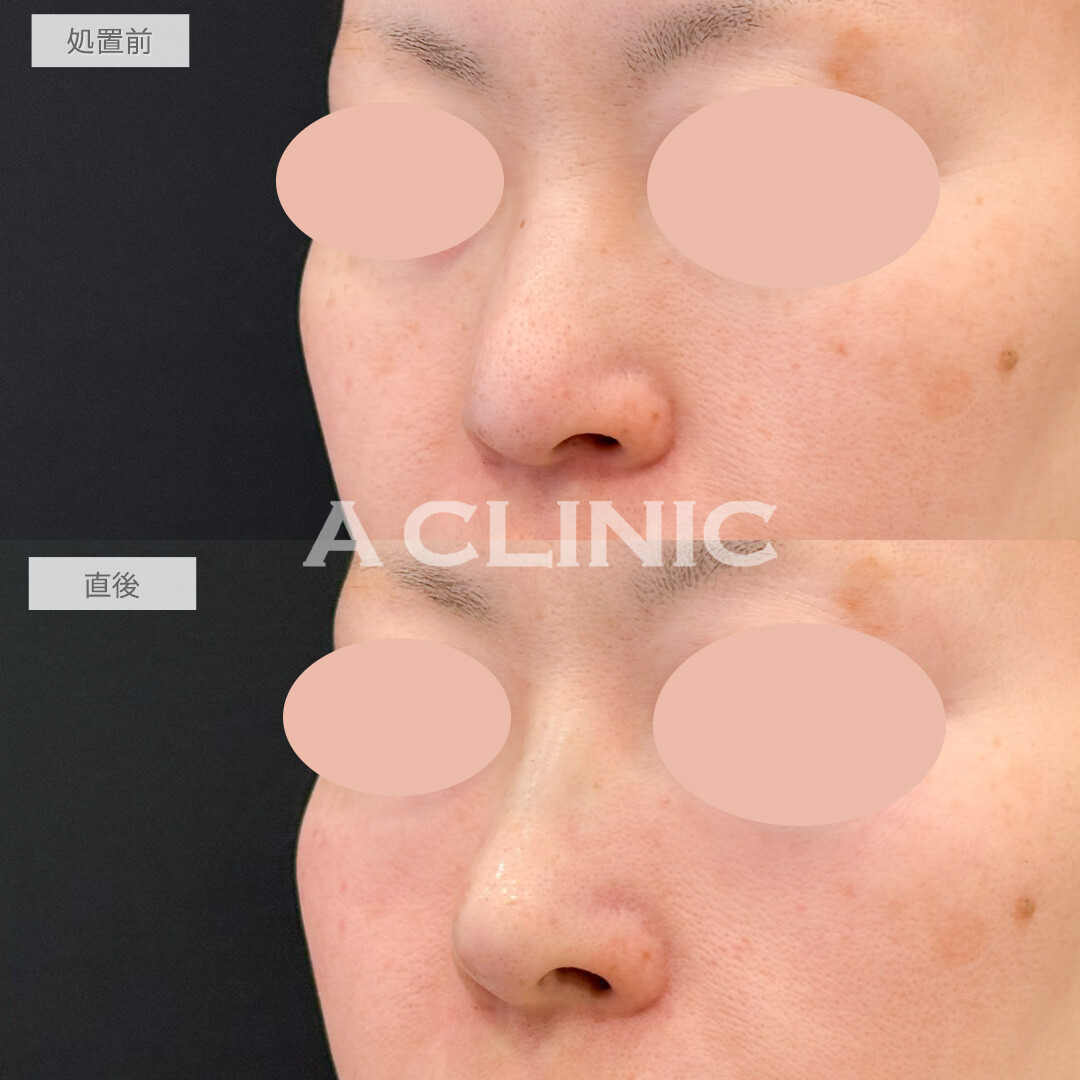 ジャスミンノーズで鼻全体を即日アップデートできました！処置前と直後の症例です(40代女性)