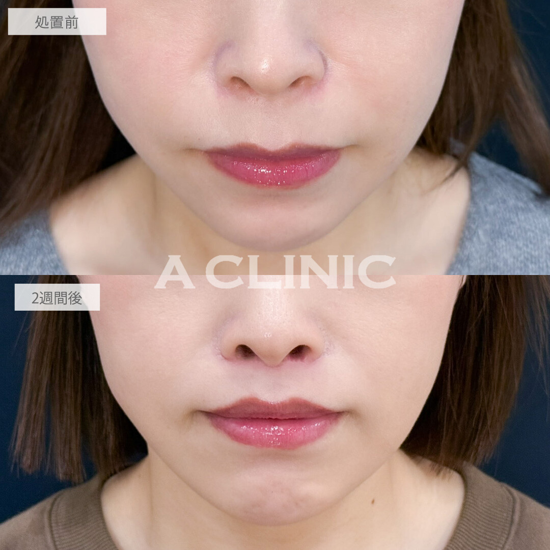 人中短縮術で鼻下が理想的な⽐率になり若々しい印象に！こちら処置前と2週間後の症例です(30代女性)