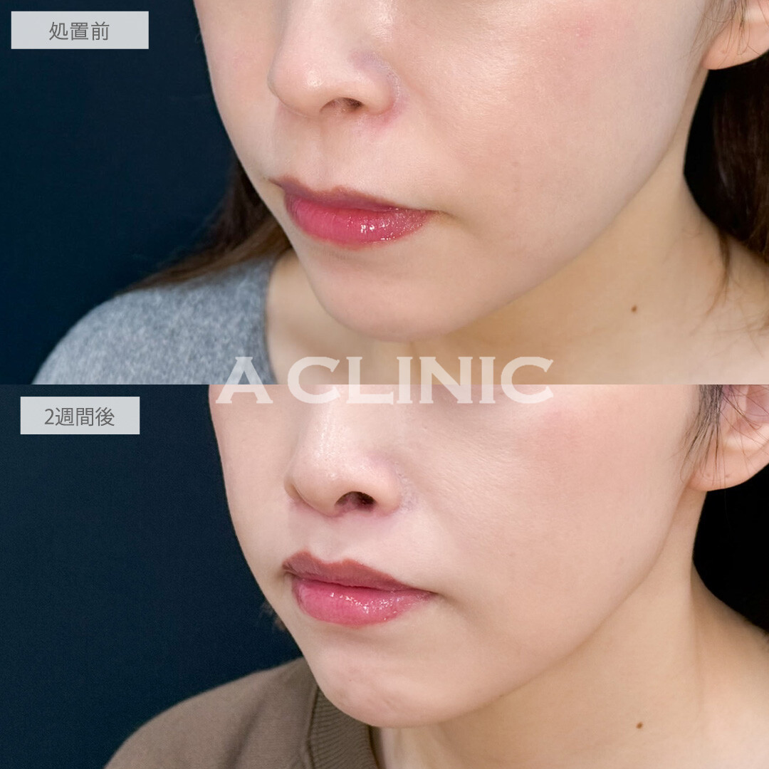 人中短縮術で鼻下が理想的な⽐率になり若々しい印象に！こちら処置前と2週間後の症例です(30代女性)