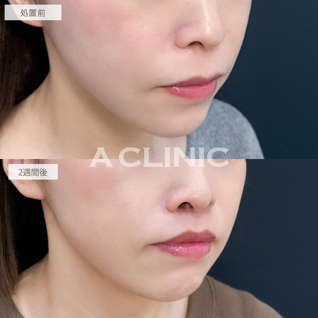人中短縮術で鼻下が理想的な⽐率になり若々しい印象に！こちら処置前と2週間後の症例です(30代女性)