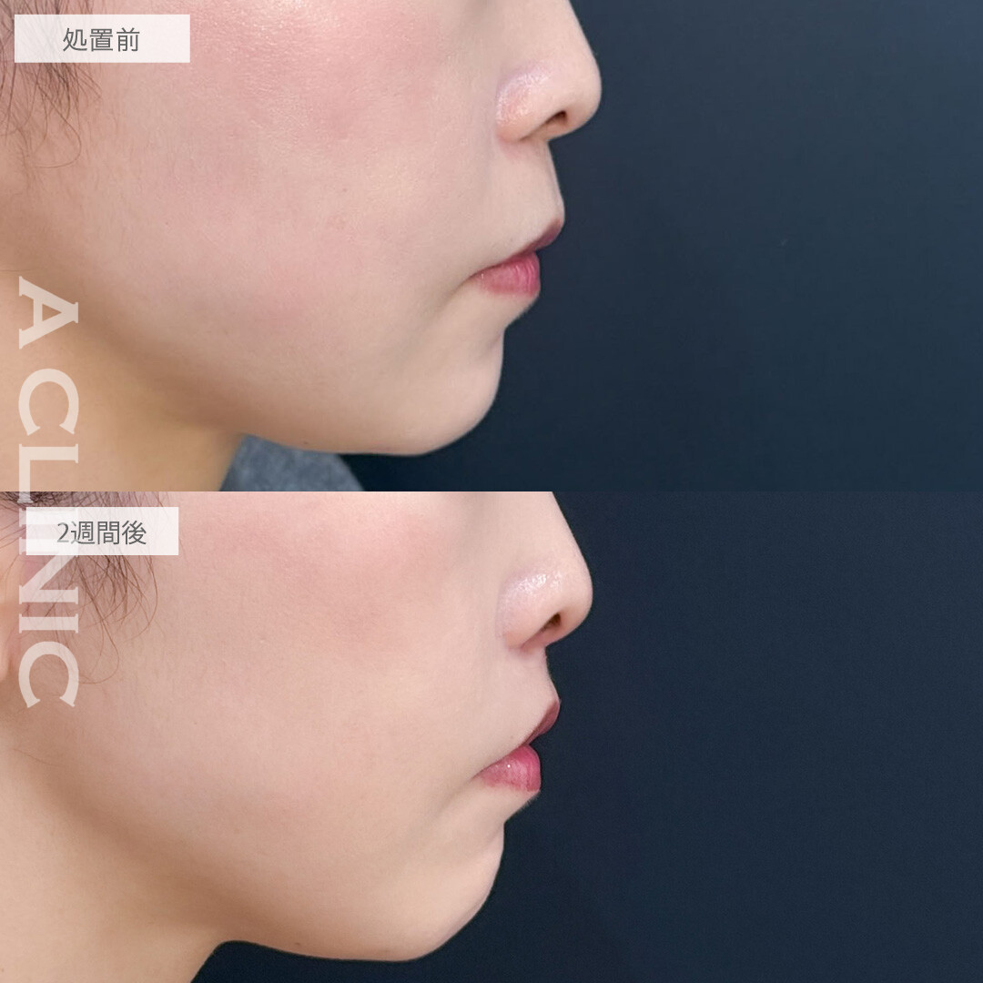 人中短縮術で鼻下が理想的な⽐率になり若々しい印象に！こちら処置前と2週間後の症例です(30代女性)