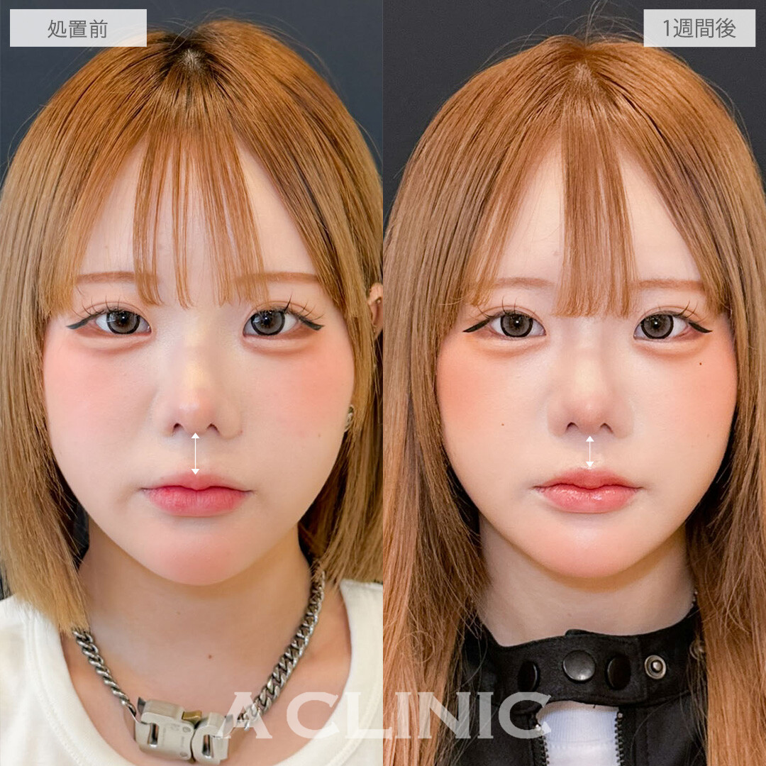 切らない人中短縮(Cカール形成術)で理想的なお顔のバランスになりました！こちら処置前と1週間後の症例です(20代女性)