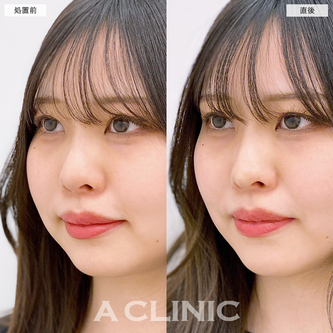 コリアンノーズで鼻の高さがアップして立体感のある美人顔に！処置前と直後の症例です(20代女性)