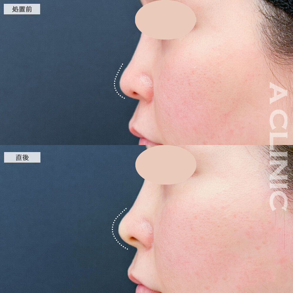 コリアンノーズで横顔が綺麗に見える鼻になりました！こちら処置前と直後の症例です(40代女性)