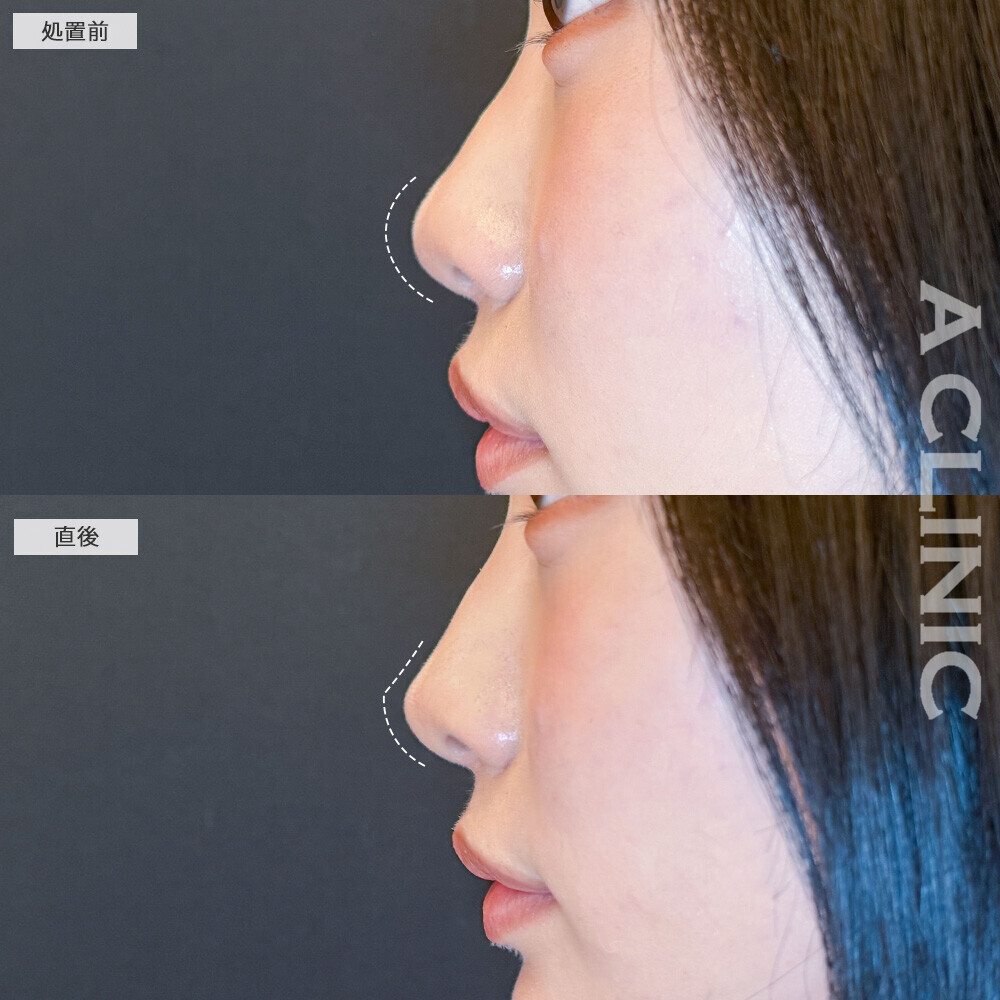 コリアンノーズで鼻先をツンとさせより盛れる横顔に！こちら処置前と直後の症例です(20代女性)