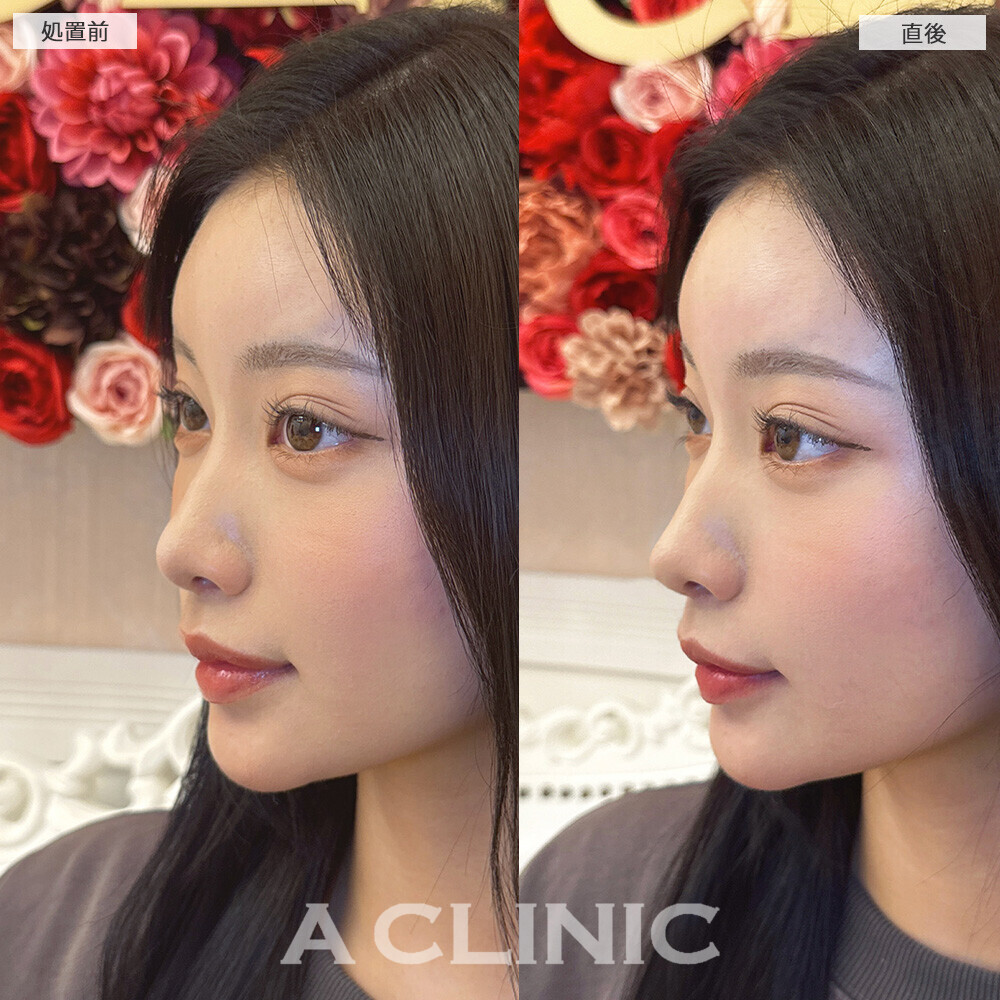 コリアンノーズで鼻先をツンとさせより盛れる横顔に！こちら処置前と直後の症例です(20代女性)