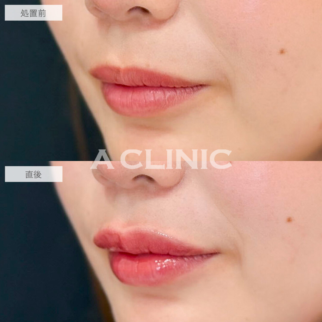 スマイルリップは人中短縮効果もあります！処置前と直後の症例です(20代女性)