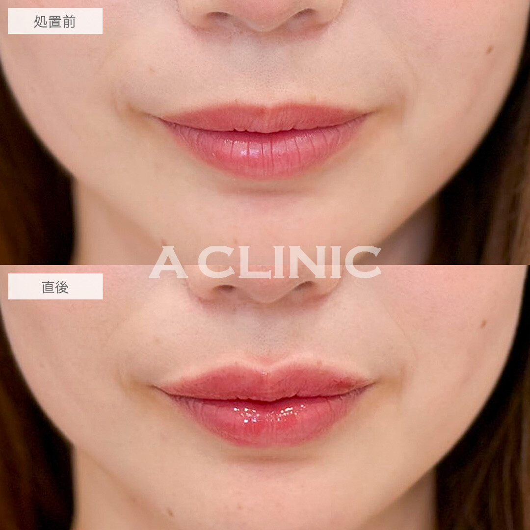スマイルリップは人中短縮効果もあります！処置前と直後の症例です(20代女性)