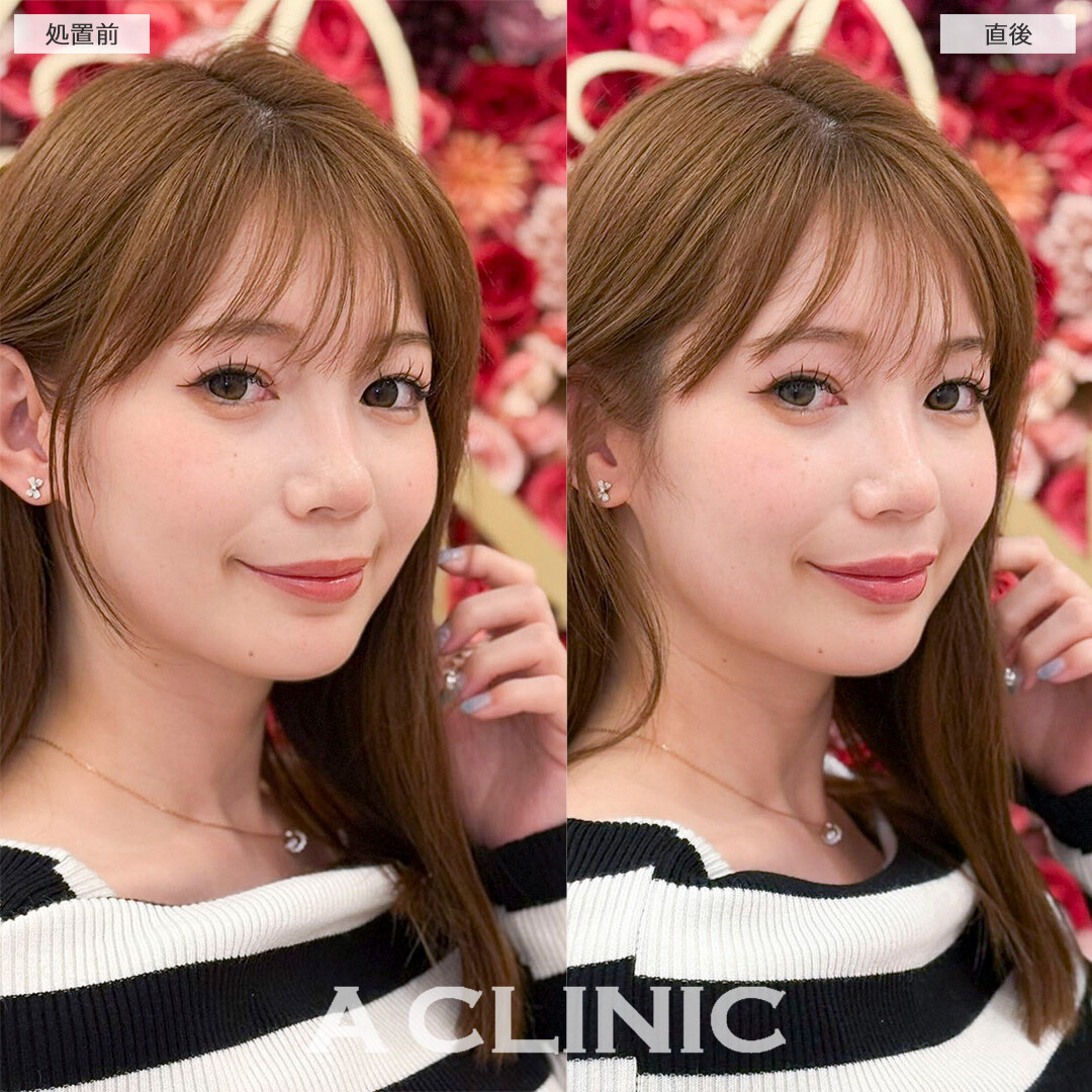 スマイルリップは人中短縮効果もあります！処置前と直後の症例です(20代女性)