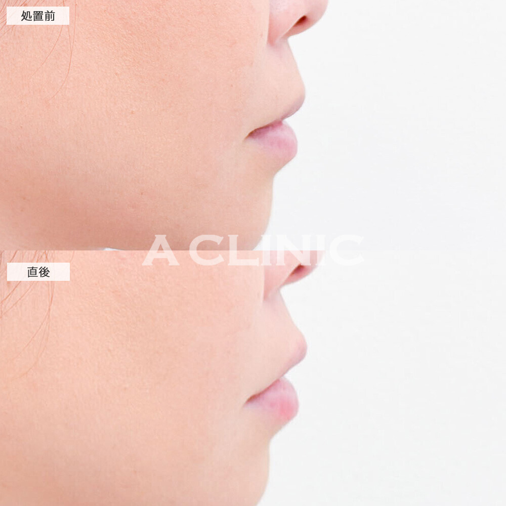 リップヒアルロン酸注入でどこから見ても立体的なリップになりました！こちら処置前と直後の症例です(30代女性)