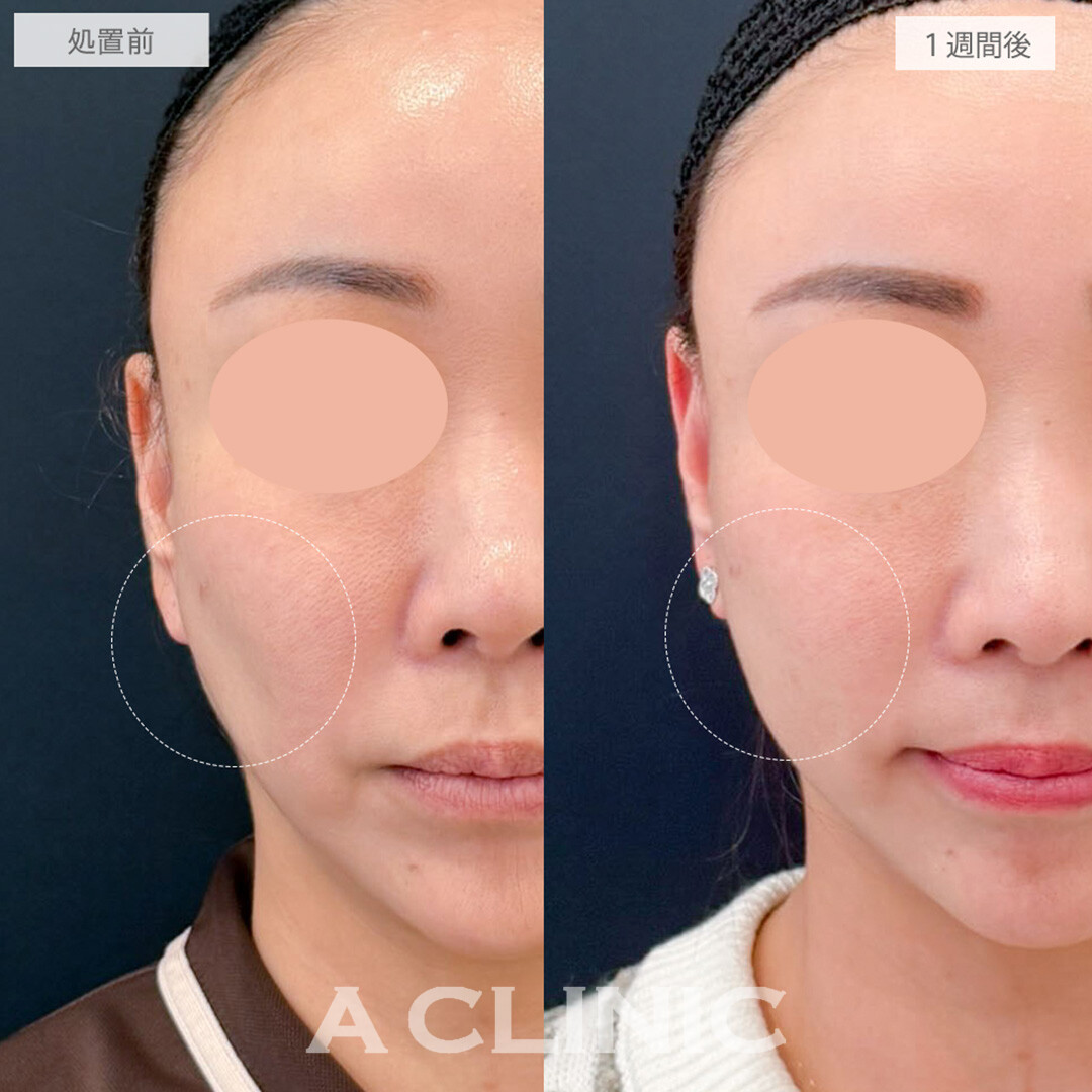 頬へのヒアルロン酸注入で頬コケがなくなり若々しい印象へと大変身！処置前と1週間後の症例です(40代女性)