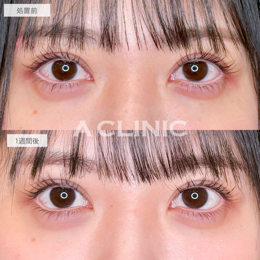 パーフェクトアイズで左右差も改善されお人形さんのような可愛らしいお目元に！処置前と1週間後の症例です(20代女性)