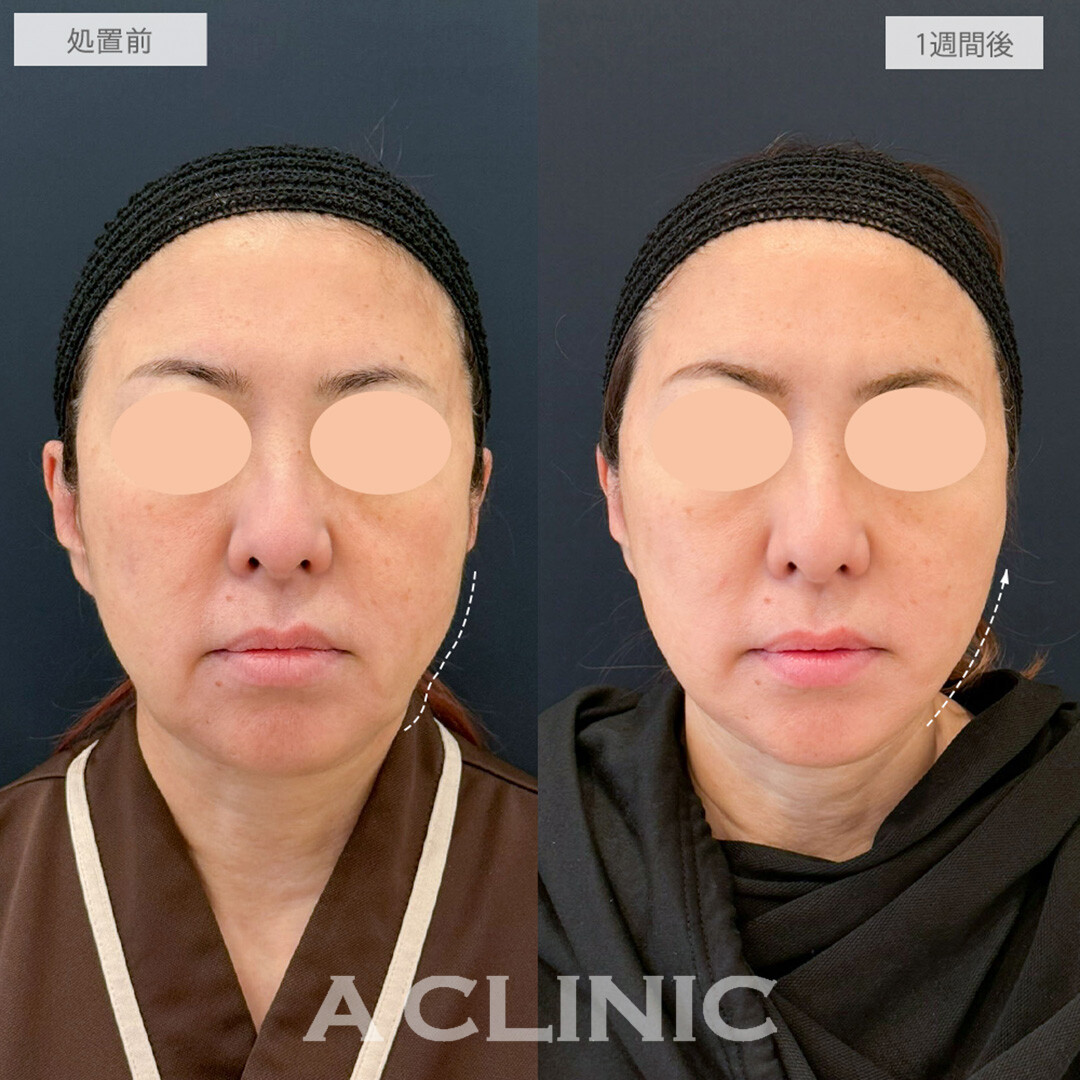 A式たるみ切開でフェイスラインのもたつきがスッキリと綺麗になりました！処置前と1週間後の症例です(60代女性)