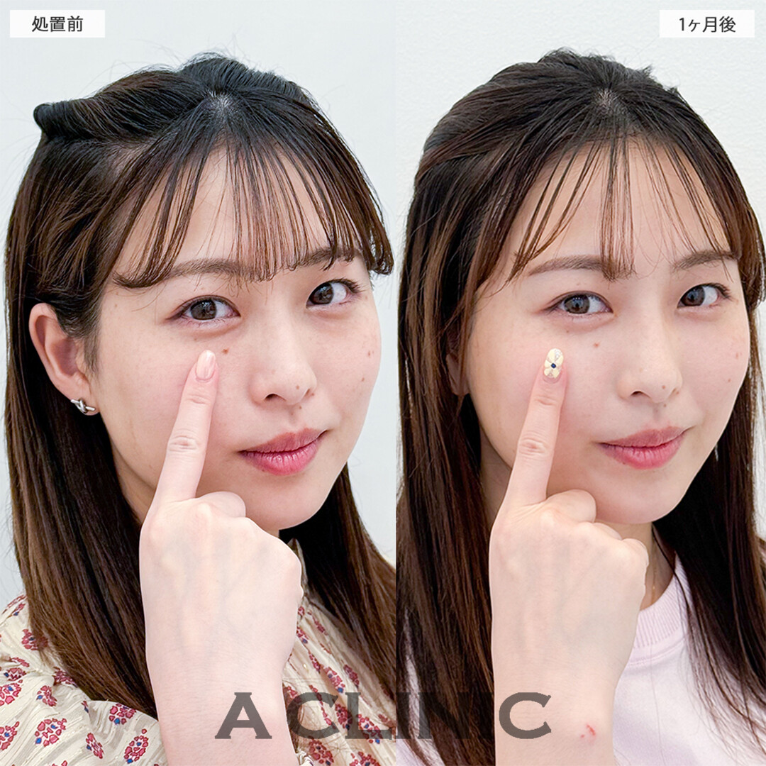 目の下のクマ取りでコンシーラーいらずの目元へ！こちら処置前と1ヶ月後の症例です(20代女性)