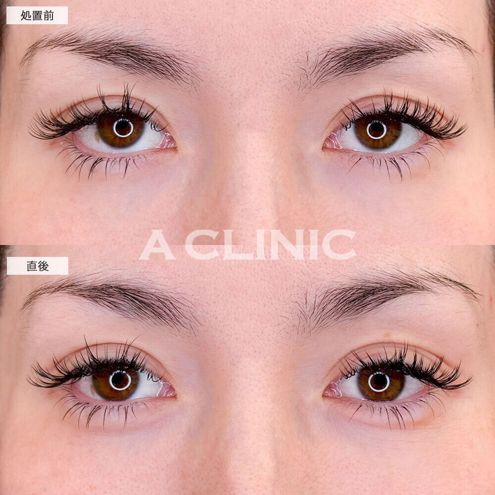 涙袋形成術(ヒアルロン酸)で目の縦幅アップ！処置前と直後の症例です(30代女性)