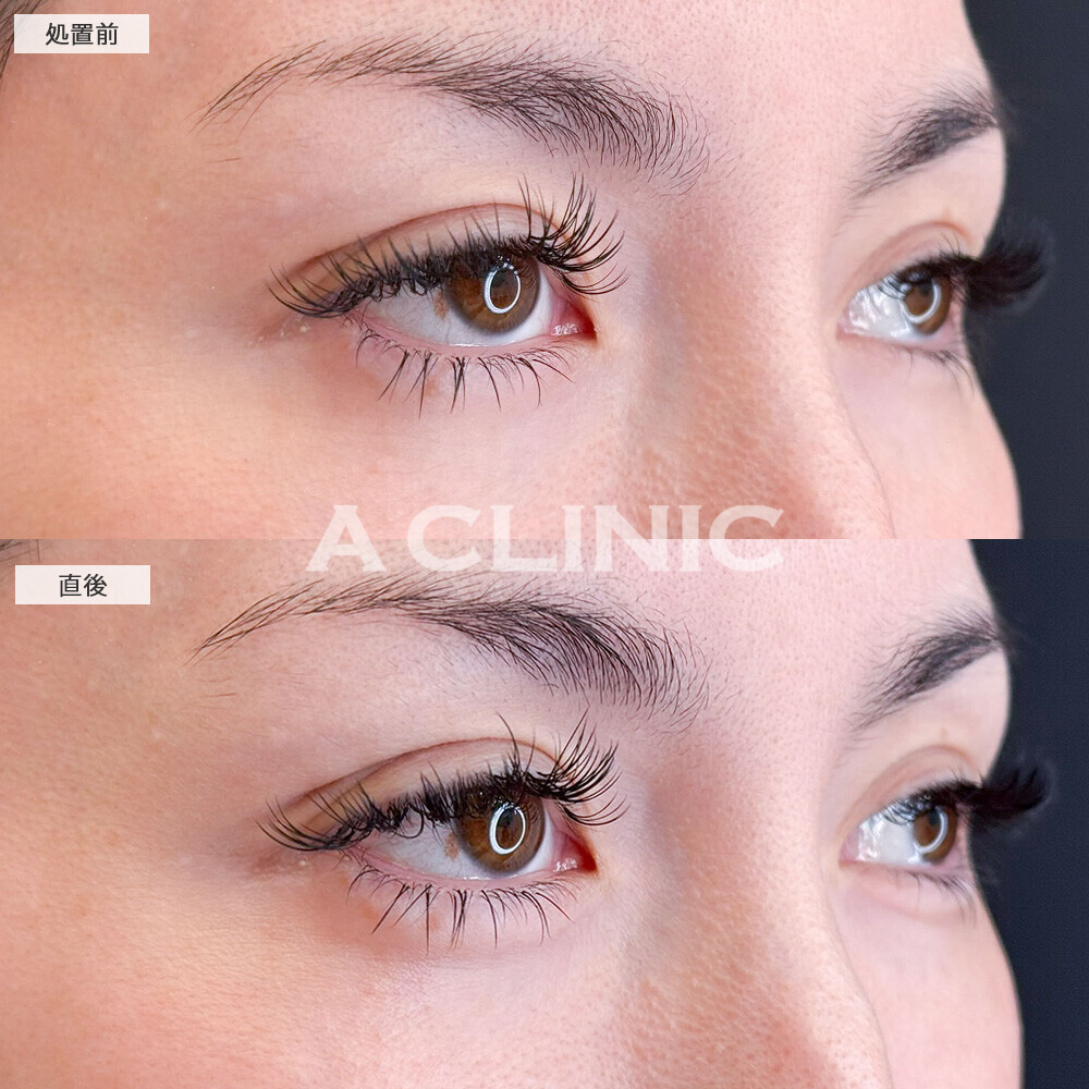 涙袋形成術(ヒアルロン酸)で目の縦幅アップ！処置前と直後の症例です(30代女性)