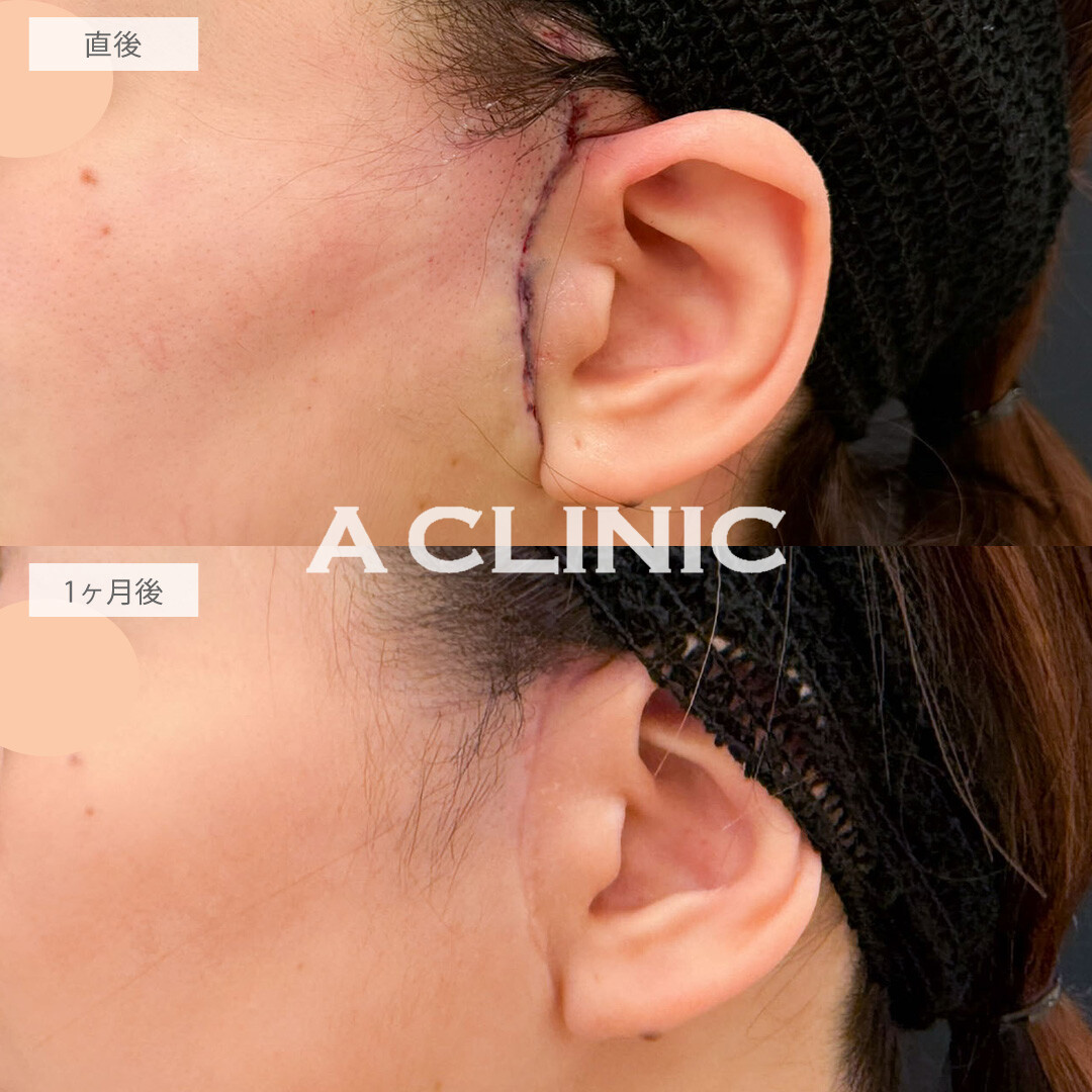 A式ナゾラリフトで口元のもたつきとほうれい線を改善しました！こちら処置前と1か月後の症例です(30代女性)