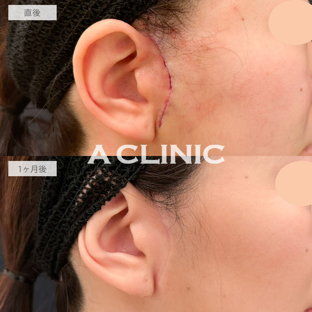 A式ナゾラリフトで口元のもたつきとほうれい線を改善しました！こちら処置前と1か月後の症例です(30代女性)