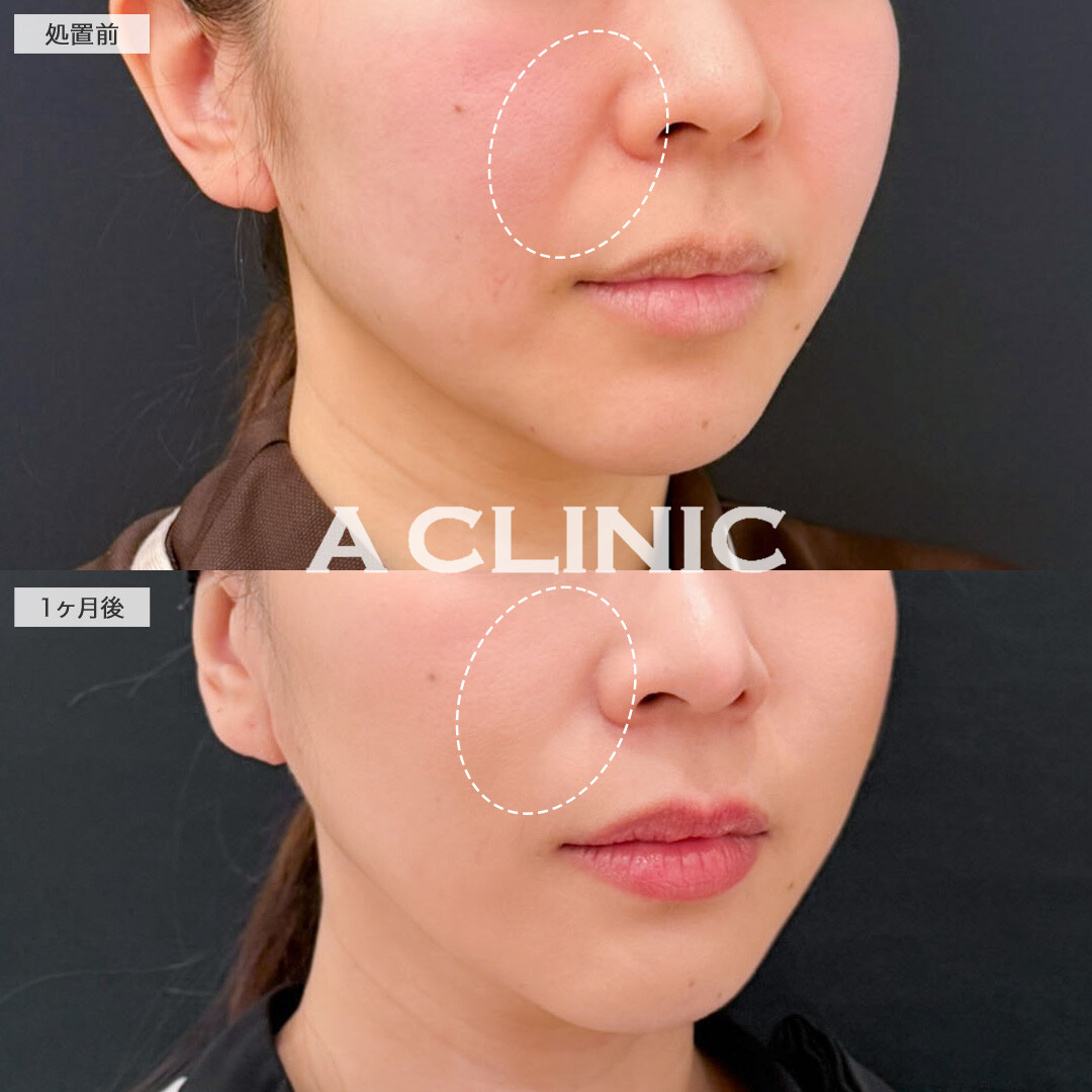 A式ナゾラリフトで口元のもたつきとほうれい線を改善しました！こちら処置前と1か月後の症例です(30代女性)