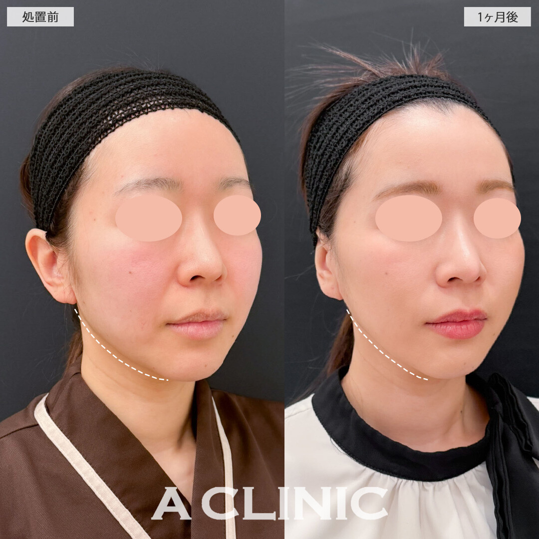 A式ナゾラリフトで口元のもたつきとほうれい線を改善しました！こちら処置前と1か月後の症例です(30代女性)