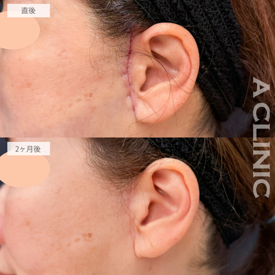 【直後の傷跡あり】A式ナゾラリフトとバッカルファット除去術でたるみも脂肪もすっきり！こちら処置前と2ヶ月後の症例です(60代女性)