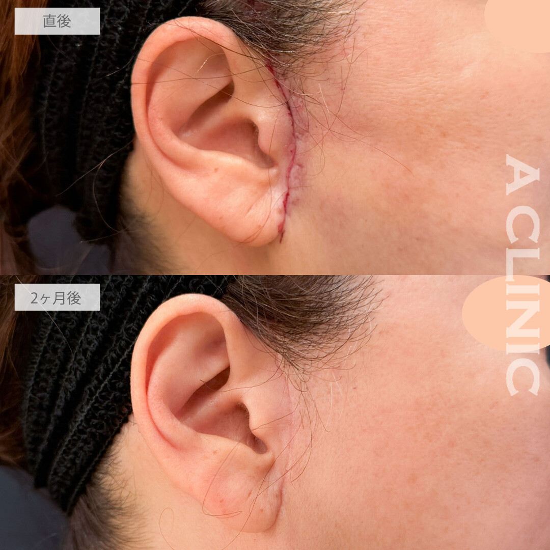 【直後の傷跡あり】A式ナゾラリフトとバッカルファット除去術でたるみも脂肪もすっきり！こちら処置前と2ヶ月後の症例です(60代女性)