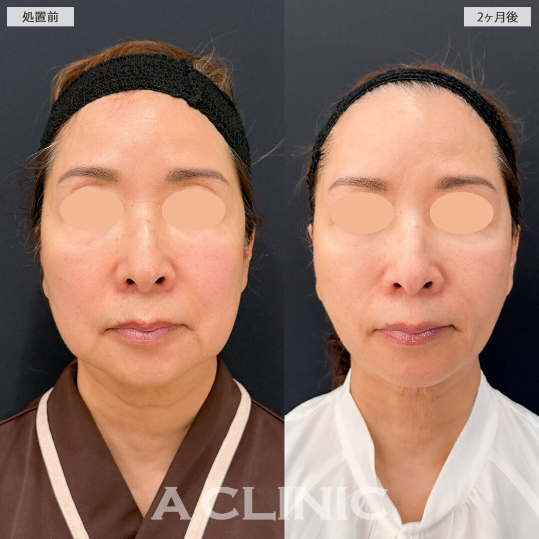 【直後の傷跡あり】A式ナゾラリフトとバッカルファット除去術でたるみも脂肪もすっきり！こちら処置前と2ヶ月後の症例です(60代女性)