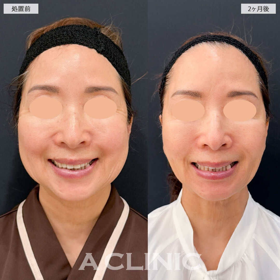 【直後の傷跡あり】A式ナゾラリフトとバッカルファット除去術でたるみも脂肪もすっきり！こちら処置前と2ヶ月後の症例です(60代女性)