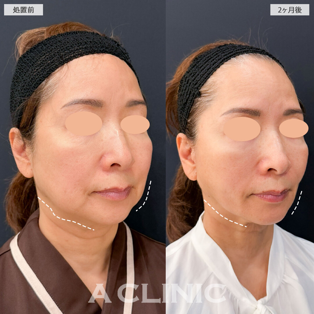 【直後の傷跡あり】A式ナゾラリフトとバッカルファット除去術でたるみも脂肪もすっきり！こちら処置前と2ヶ月後の症例です(60代女性)