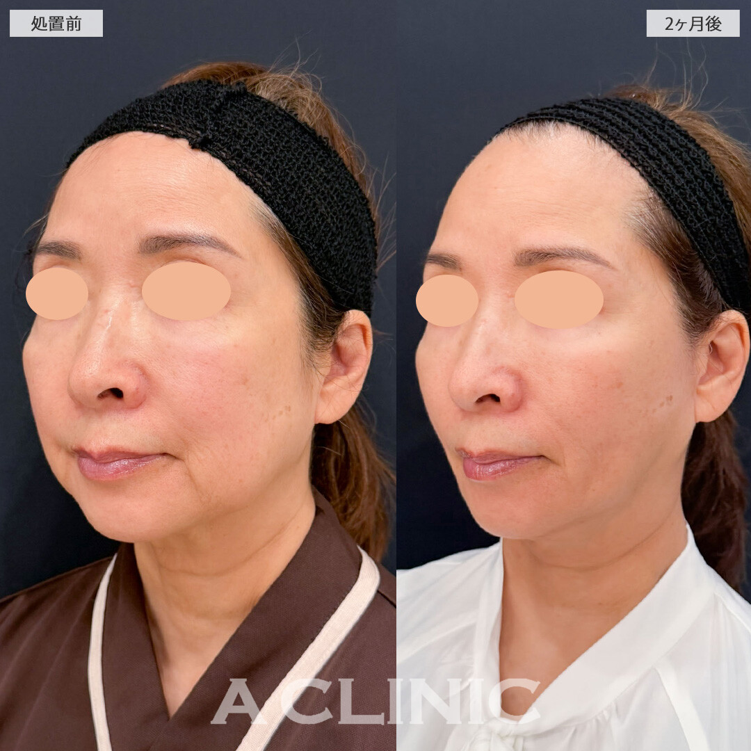 【直後の傷跡あり】A式ナゾラリフトとバッカルファット除去術でたるみも脂肪もすっきり！こちら処置前と2ヶ月後の症例です(60代女性)