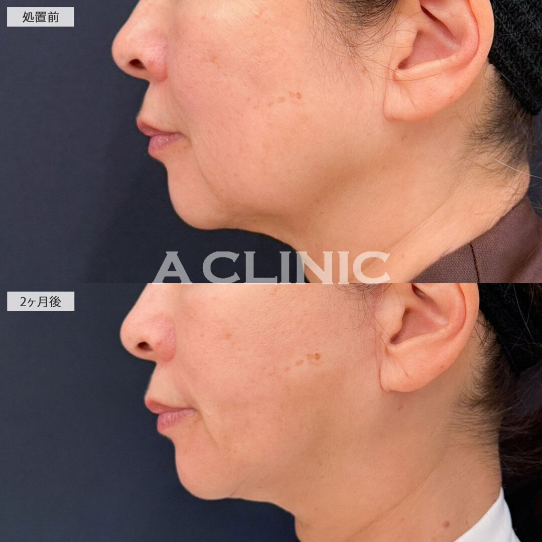 【直後の傷跡あり】A式ナゾラリフトとバッカルファット除去術でたるみも脂肪もすっきり！こちら処置前と2ヶ月後の症例です(60代女性)
