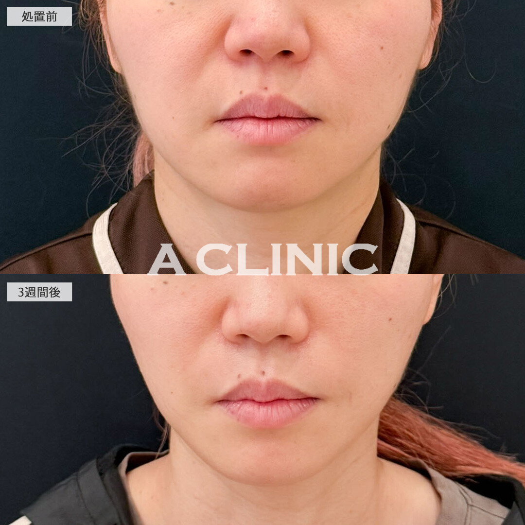 【直後の傷跡あり】A式ナゾラリフトでたるみ感軽減してすっきり見えが叶いました！こちら処置前と3週間後の症例です(40代女性)