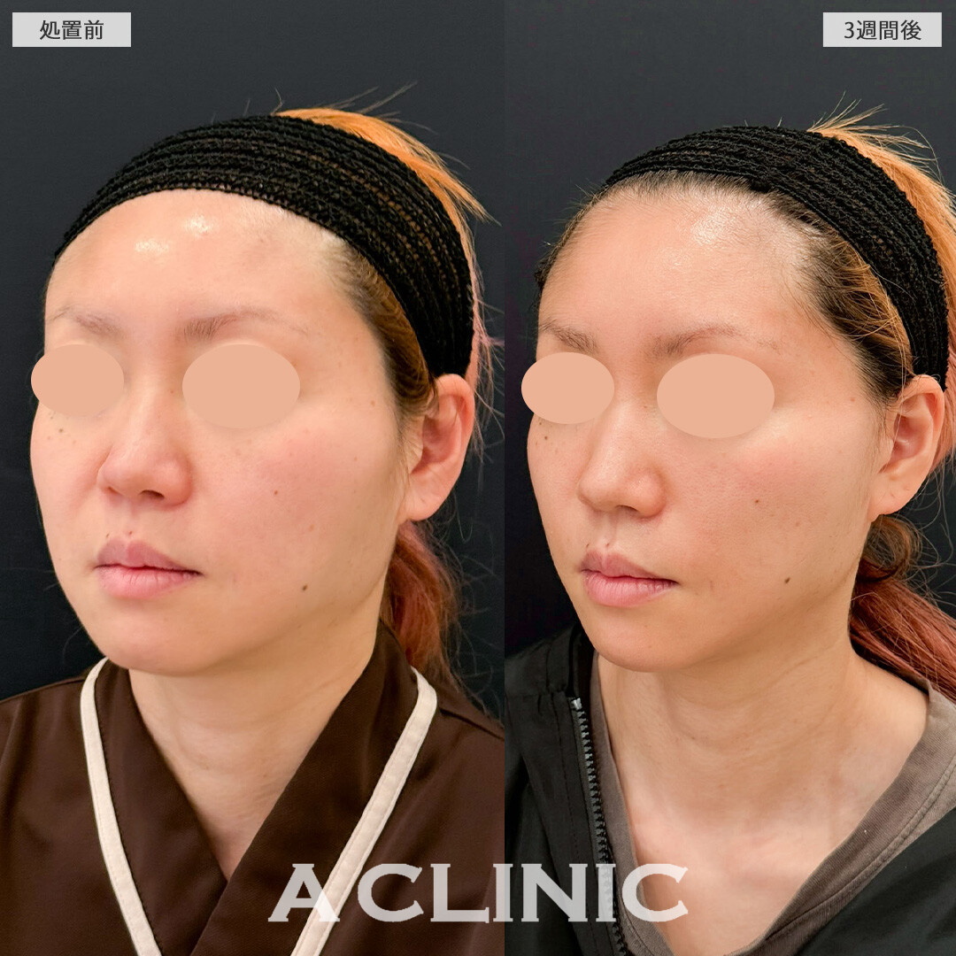 【直後の傷跡あり】A式ナゾラリフトでたるみ感軽減してすっきり見えが叶いました！こちら処置前と3週間後の症例です(40代女性)